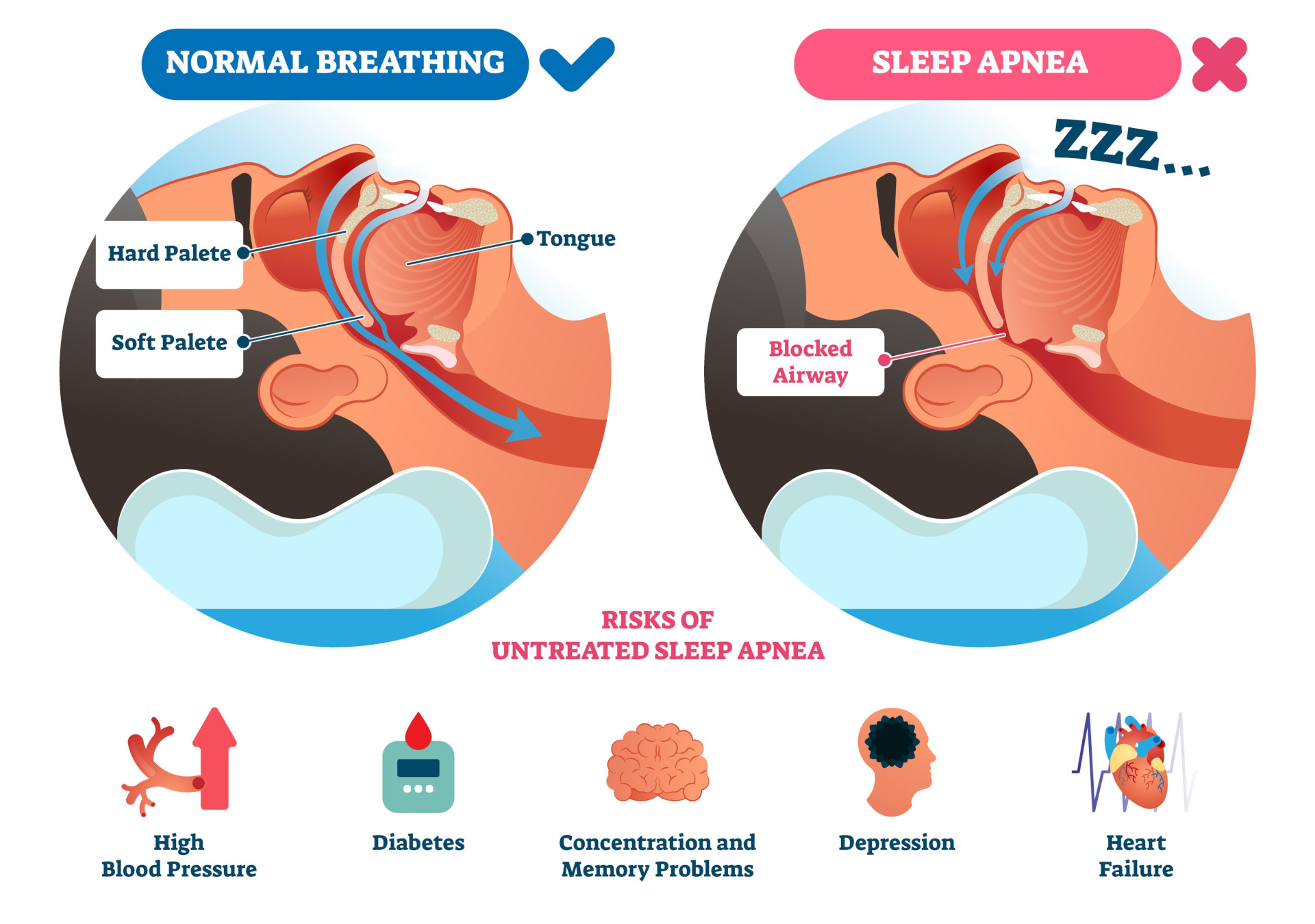 Sleep Apnea Lakeside Medical Supplies Vernon BC