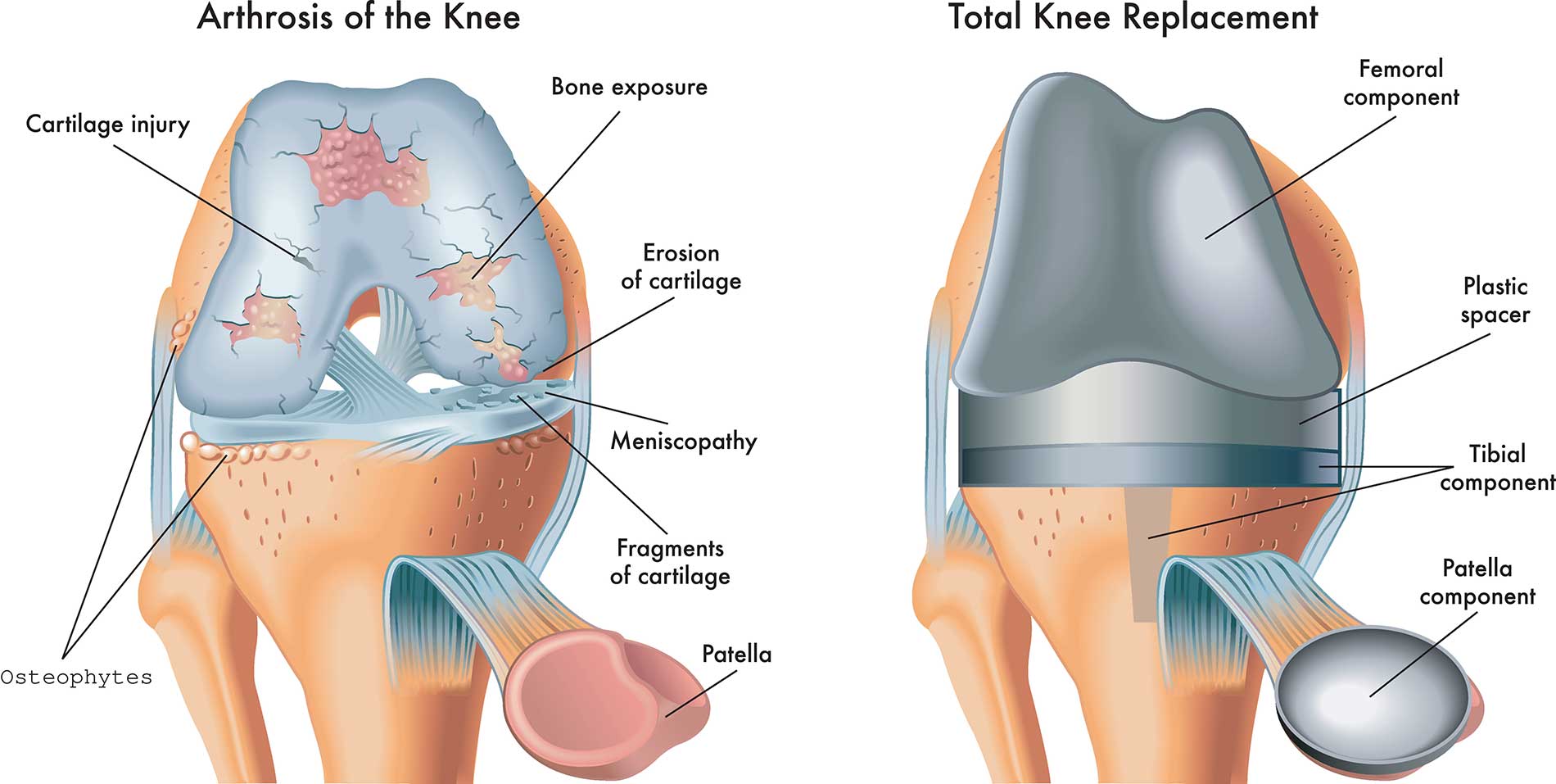 featuredimage-Everything-You-Need-to-Know-About-Knee-Replacement-Surgery