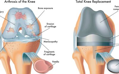 Everything You Need to Know About Knee Replacement Surgery