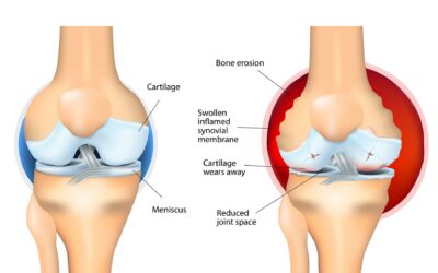 What is rheumatoid arthritis?