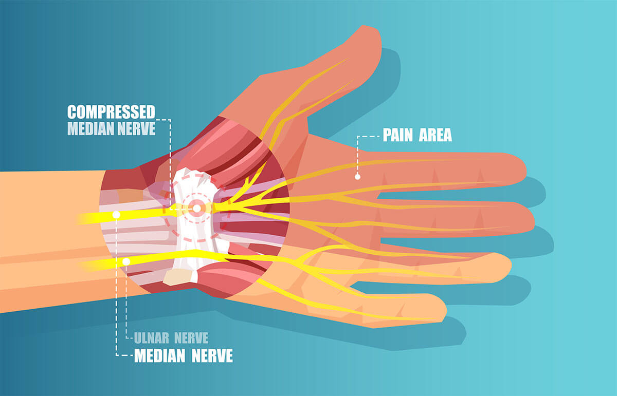 nerve compression carpal tunnel